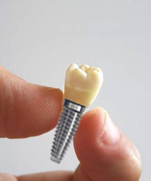 Dental clinic in nagpur - Dental Implants