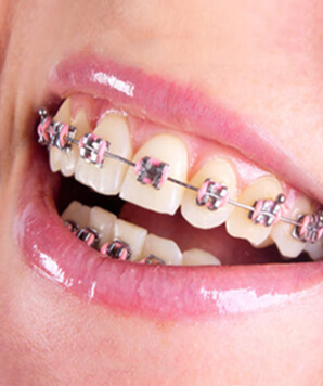 Dental clinic in nagpur - Orthodontics